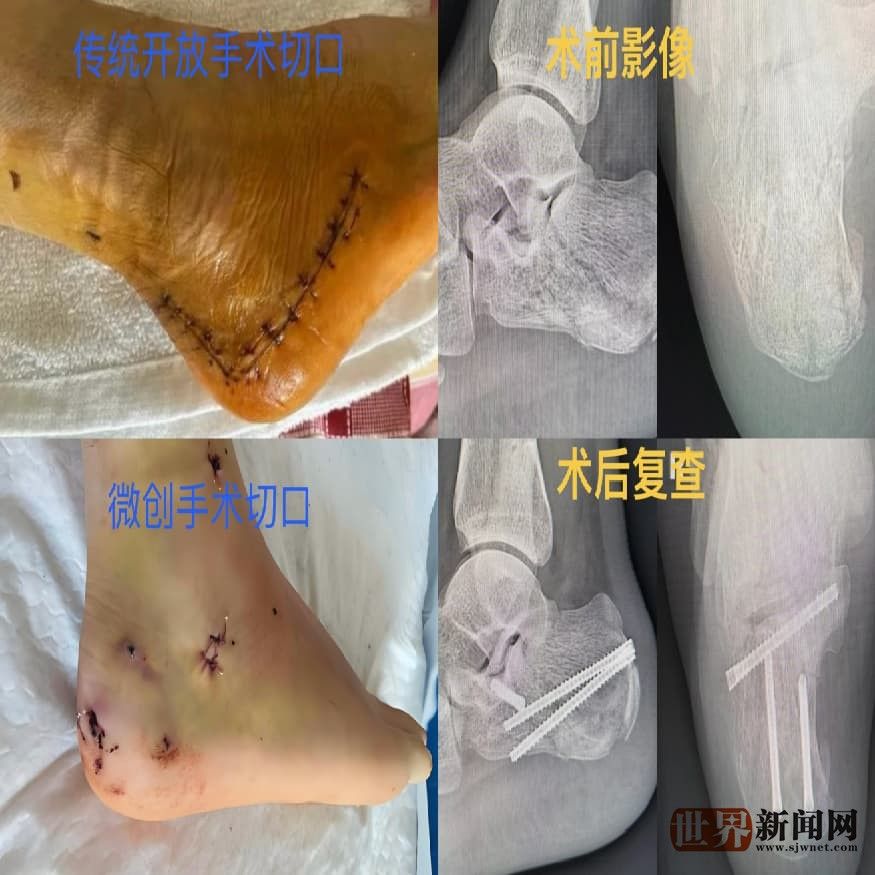 足踝微创手术的匠心：省医帮扶专家袁心伟的“针尖芭蕾